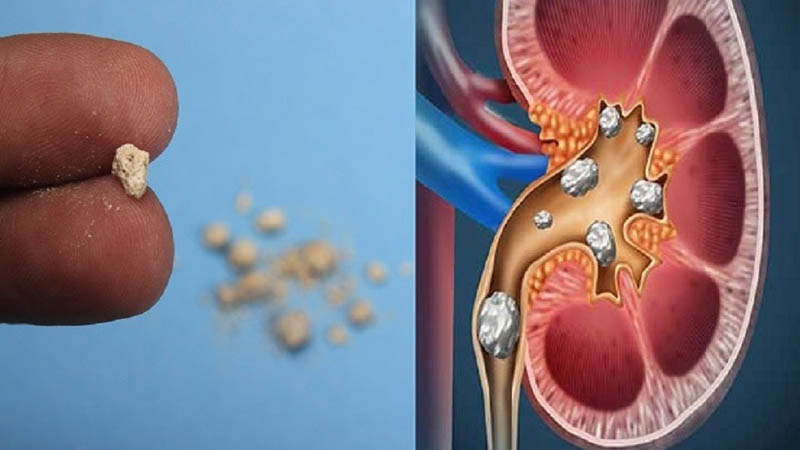 কিডনিতে পাথর হয়েছে কিনা বুঝবেন যেভাবে