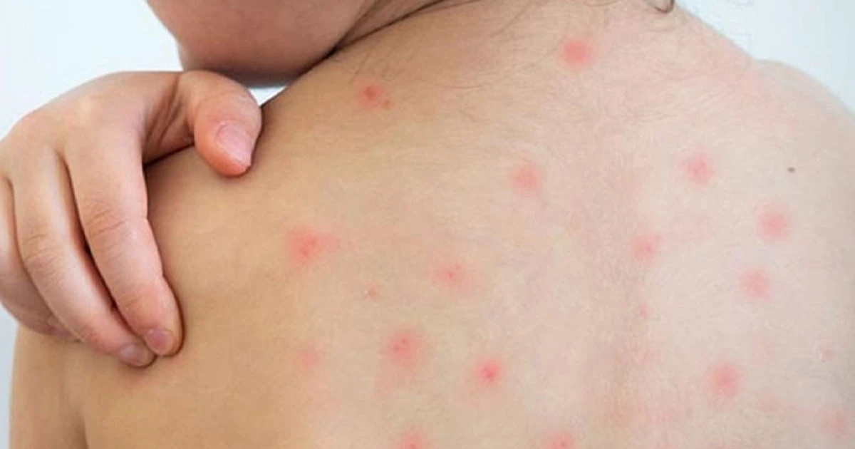 হামে আরও ৪ জনের প্রাণহানি, নতুন শনাক্ত ৬৮৫