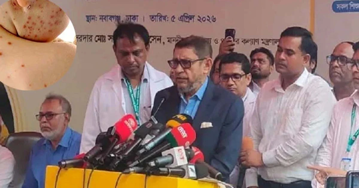 হামের টিকা সারা দেশে মিলবে ৩ মে থেকে: স্বাস্থ্যমন্ত্রী