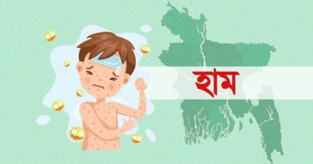 সিলেটে হাম উপসর্গ নিয়ে একদিনে ৩ শিশুর মৃত্যু