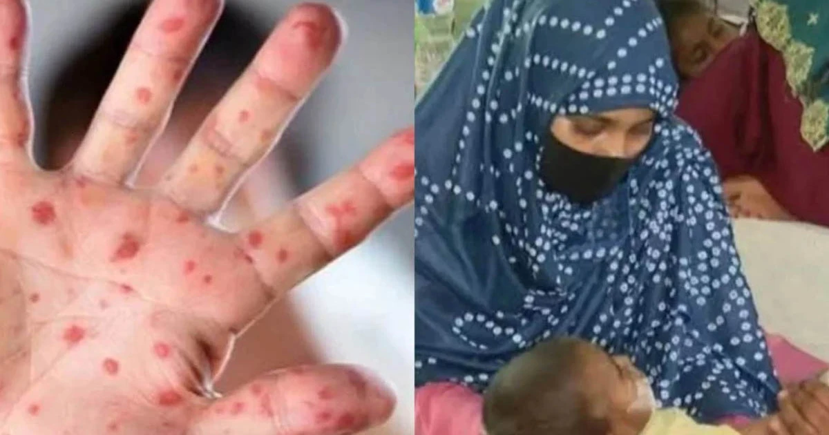 হামের উপসর্গ নিয়ে আরও চার শিশুর মৃত্যু