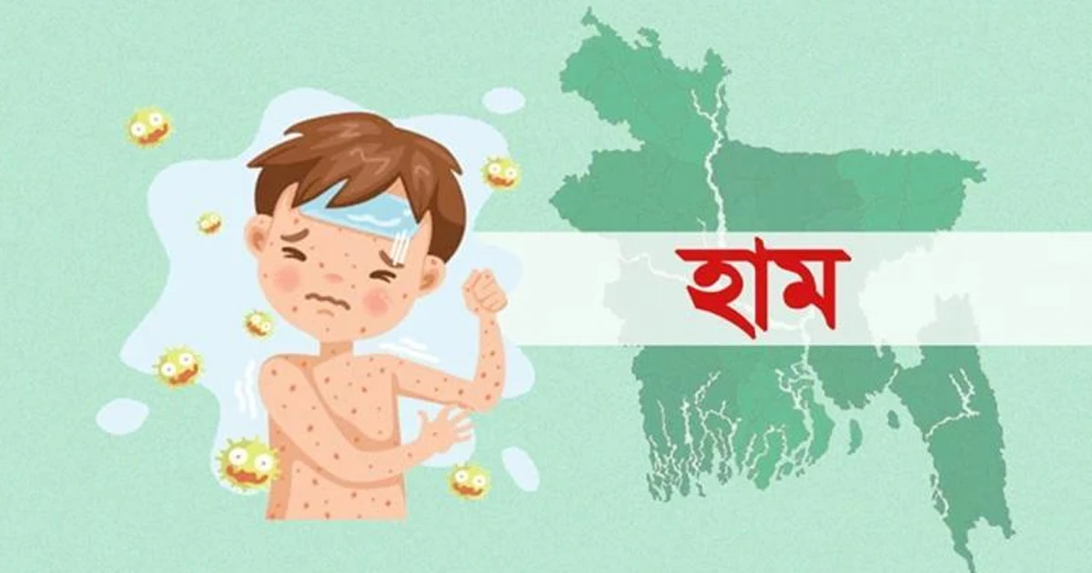 দুই মাসে হামে প্রাণ গেল ৪৫১ শিশুর