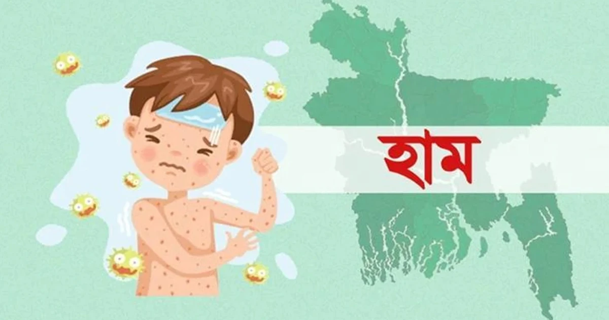 দেশে হাম ও হামের উপসর্গে আরও ৪ শিশুর মৃত্যু