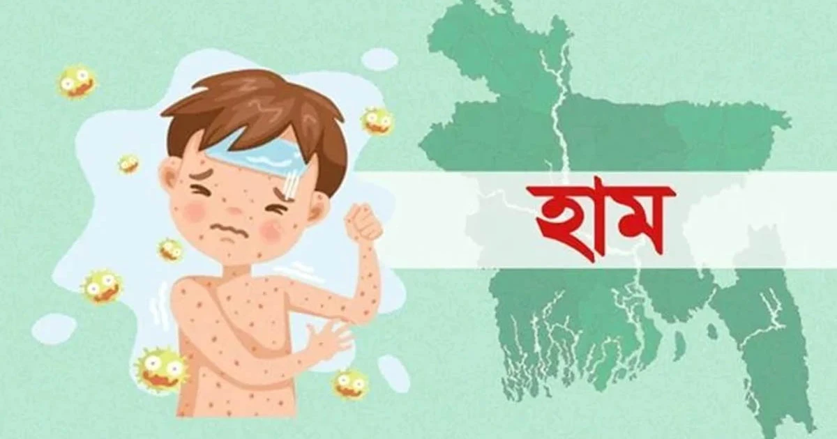 দেশে  হাম ও হামের উপসর্গে আরও ৪ জনের শিশুর মৃত্যু