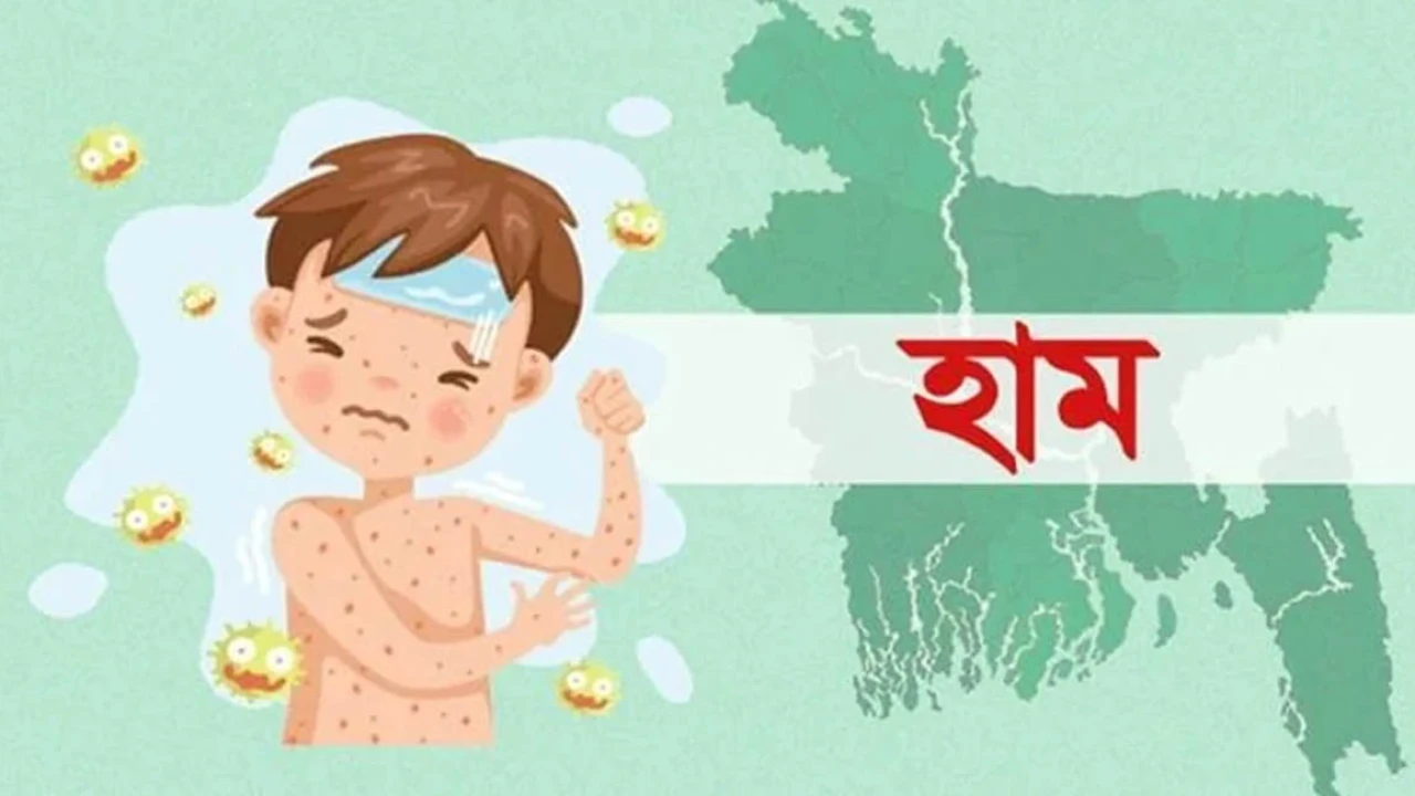 হাম ও হামের উপসর্গে আরও ৩ শিশুর মৃত্যু