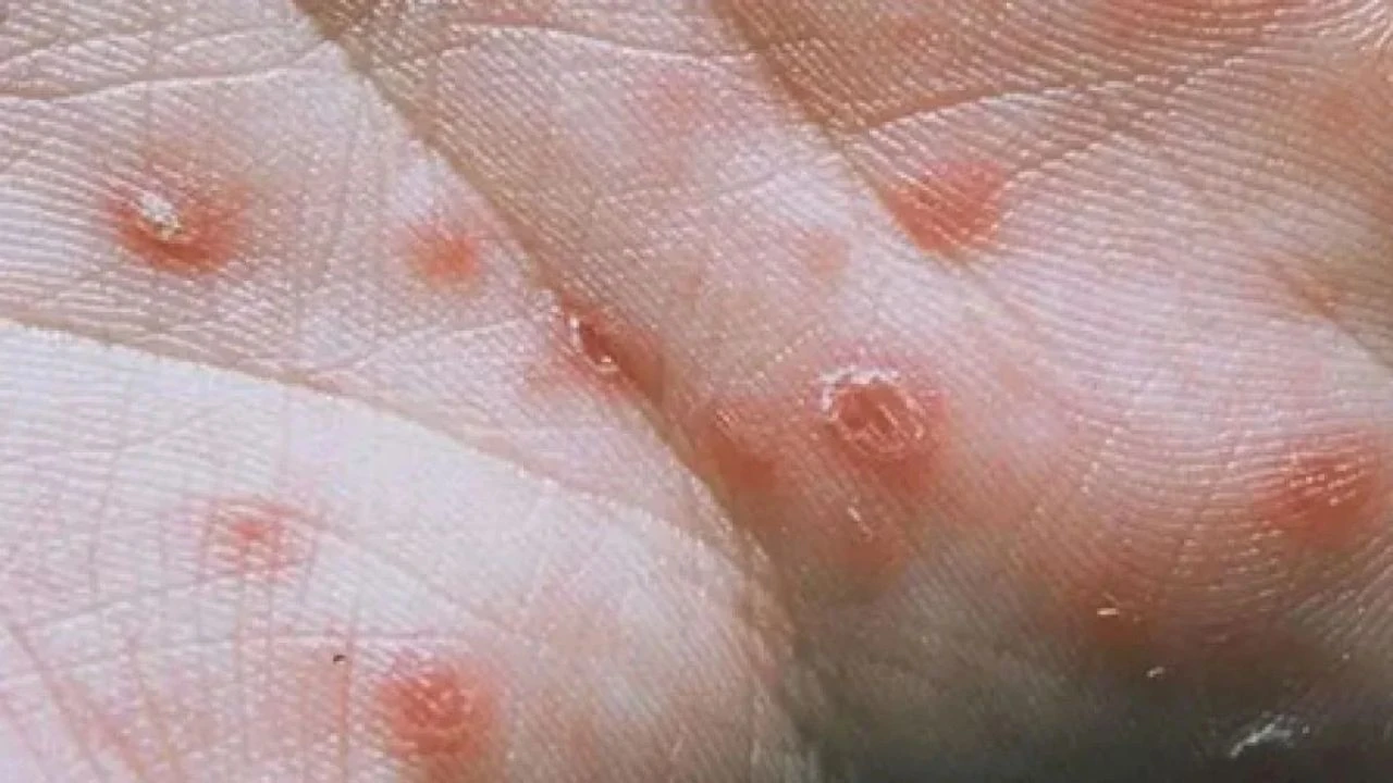 সিফিলিস কী? এ থেকে বাঁচার উপায়