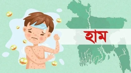 হামের উপসর্গে আরও ৪ শিশুর মৃত্যু