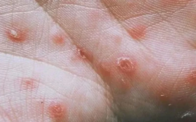 সিফিলিস কী? এ থেকে বাঁচার উপায়